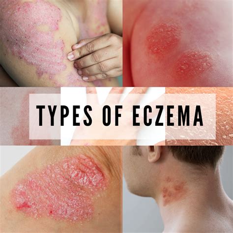 The Benefits of Magic Eczema Cream for Babies and Children